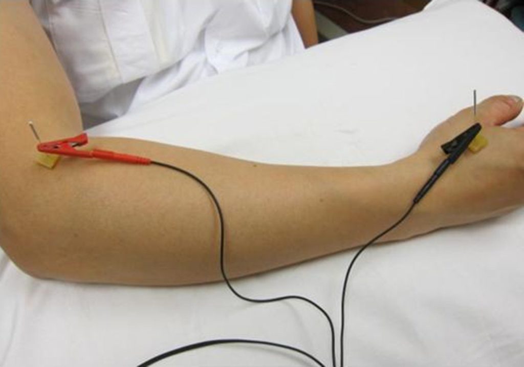 What is Electro Acupuncture? Fast Relief Acupuncture