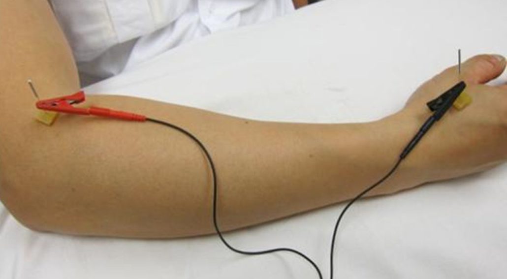 Electro-Acupuncture Electro Acupuncture