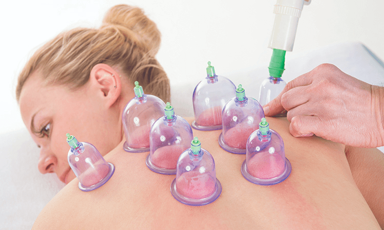 cupping cupping