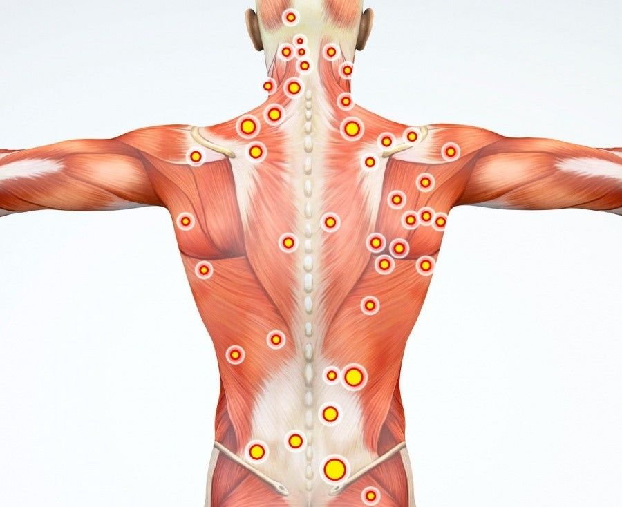 Trigger Points and Pain Fast Relief Acupuncture Franklin Lakes, NJ
