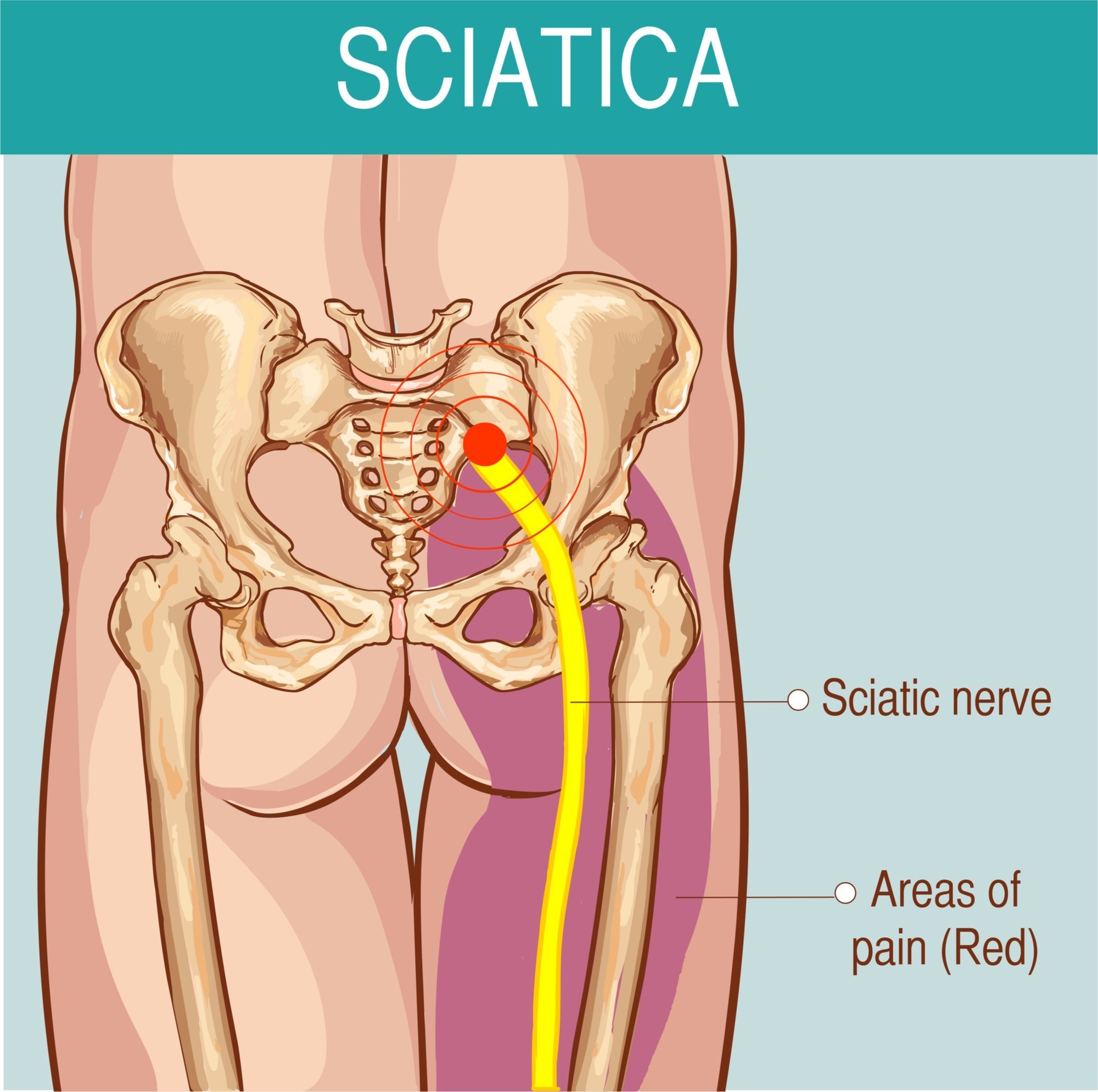 where is sciatic nerve