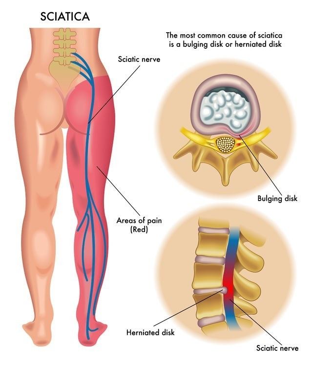 sciatica sciatica