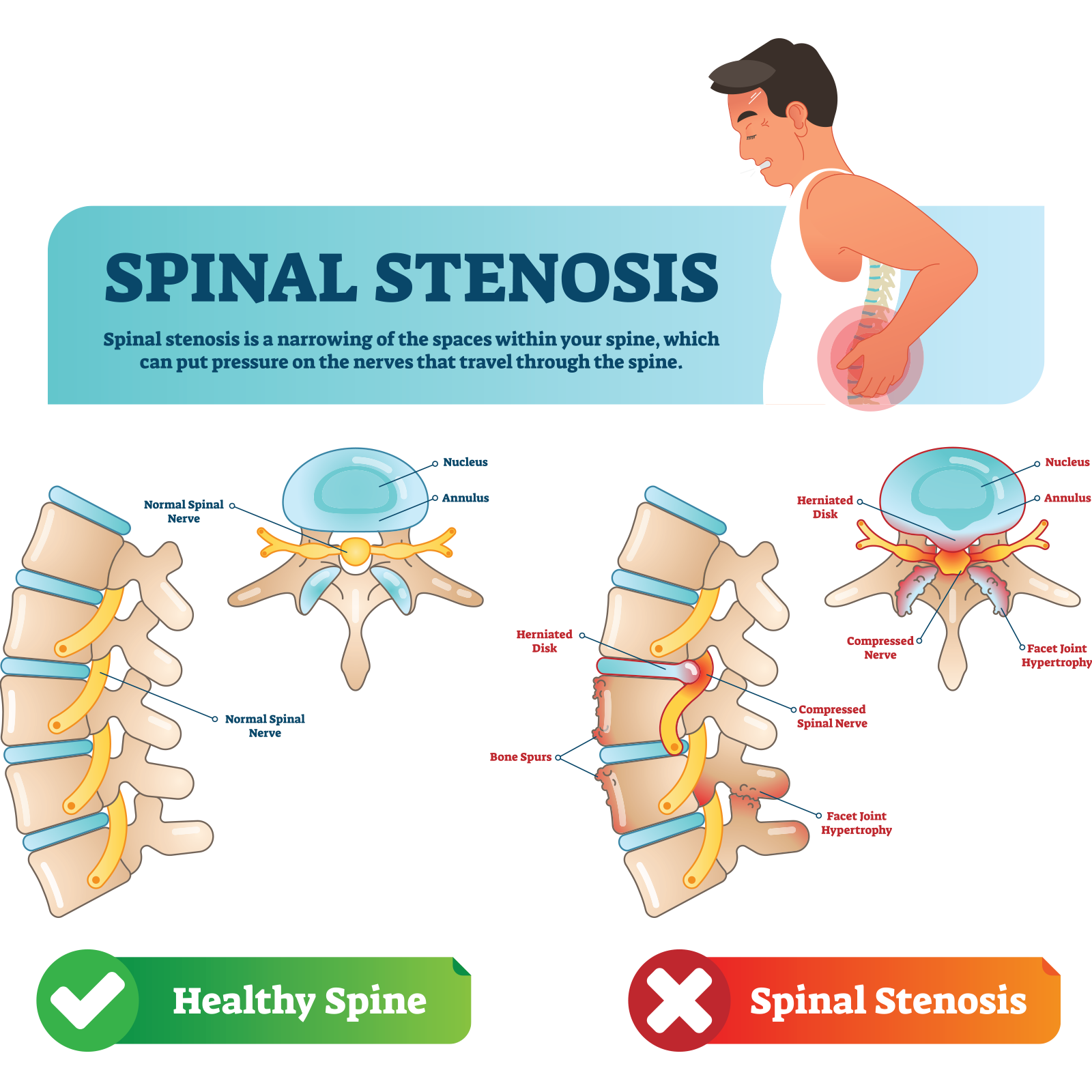 What is Spinal Stenosis? | Fast Relief Acupuncture